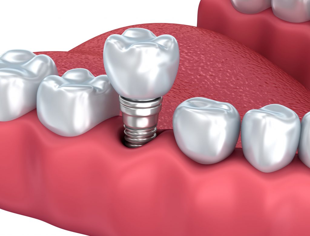 Las ventajas de los implantes dentales que debes conocer