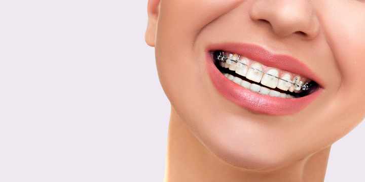 Tipos de ortodoncia: Todo lo que debes saber