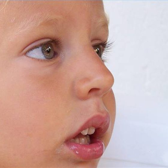 Respirar por la boca: Síndrome del respirador bucal