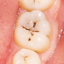 caries-todo-lo-que-necesitas-saber Caries: todo lo que necesitas saber
