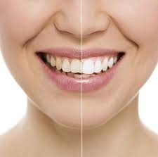 blanqueamiento-dental-tipos-y-caracteristicas Blanqueamiento dental: Tipos y características