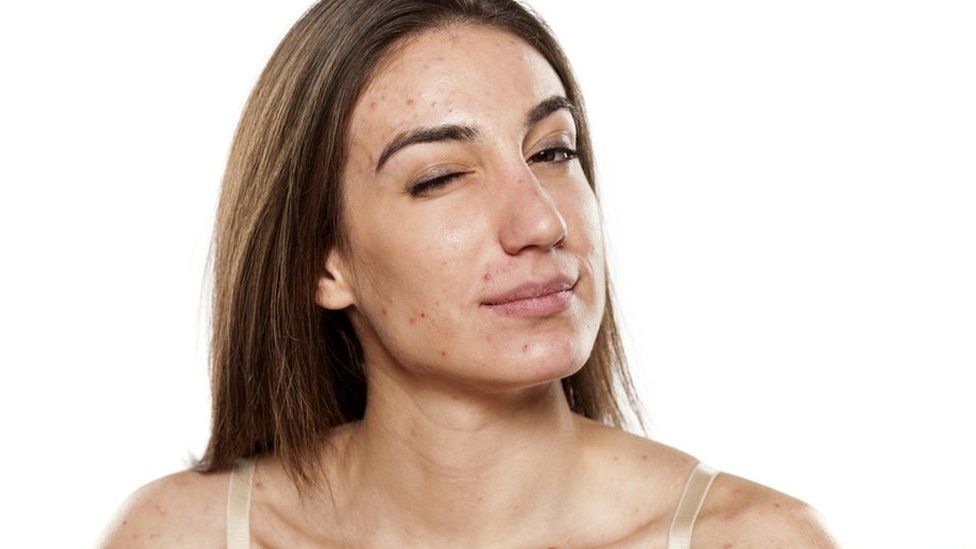 como tratar el acne y las pieles grasas