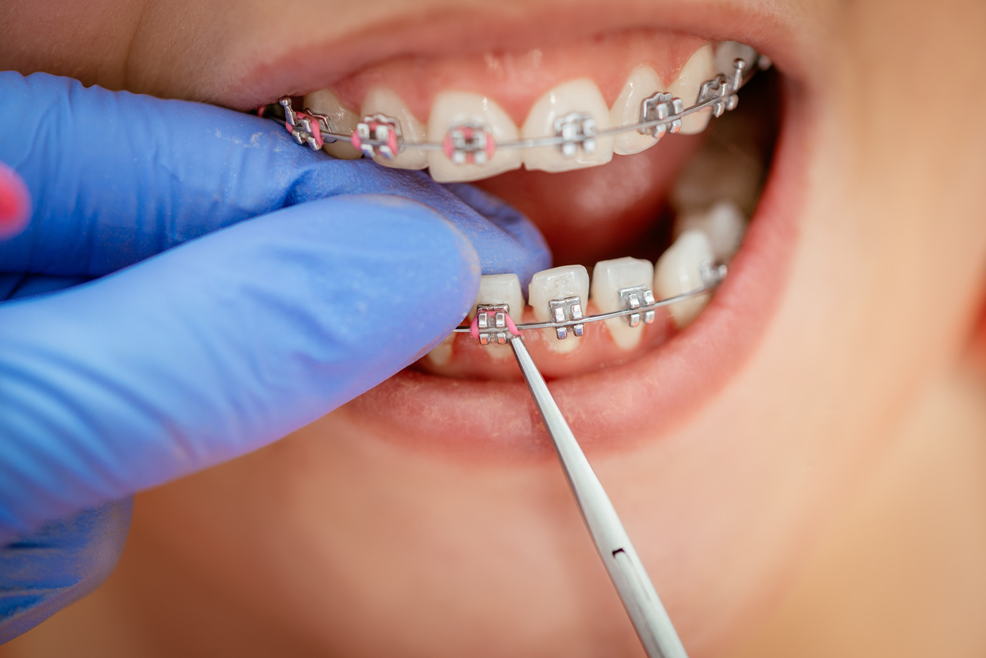 Tipos de brackets, ¿cuáles son los mejores?