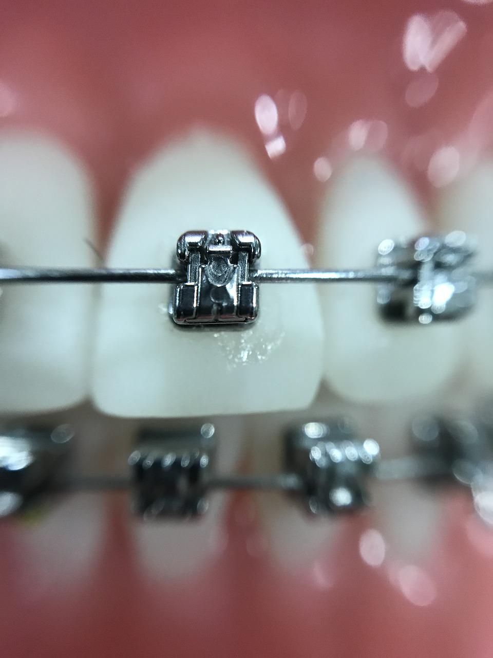 Brackets o Invisalign, ¿qué tipo de ortodoncia te interesa más?