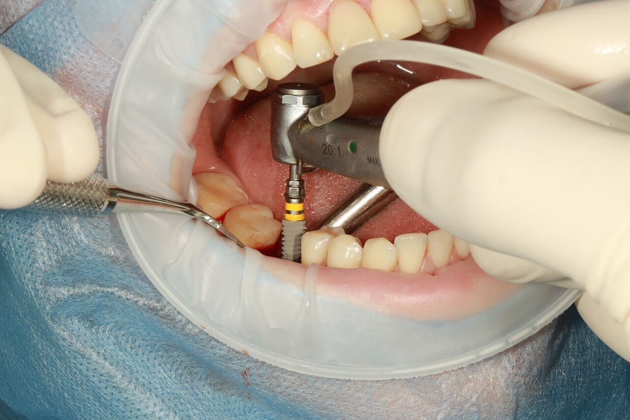 Tipos de implantes dentales