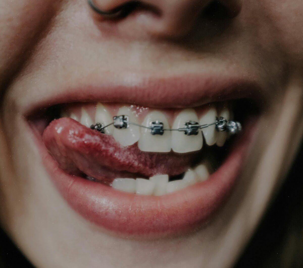 Se mueven los dientes después de una ortodoncia