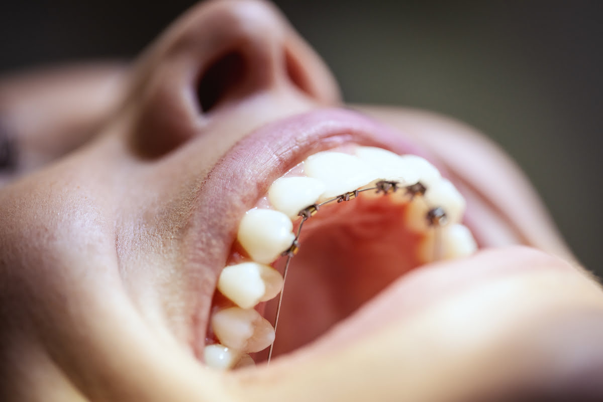 Ortodoncia lingual, esto es todo lo que debes saber sobre la ‘otra’ ortodoncia invisible