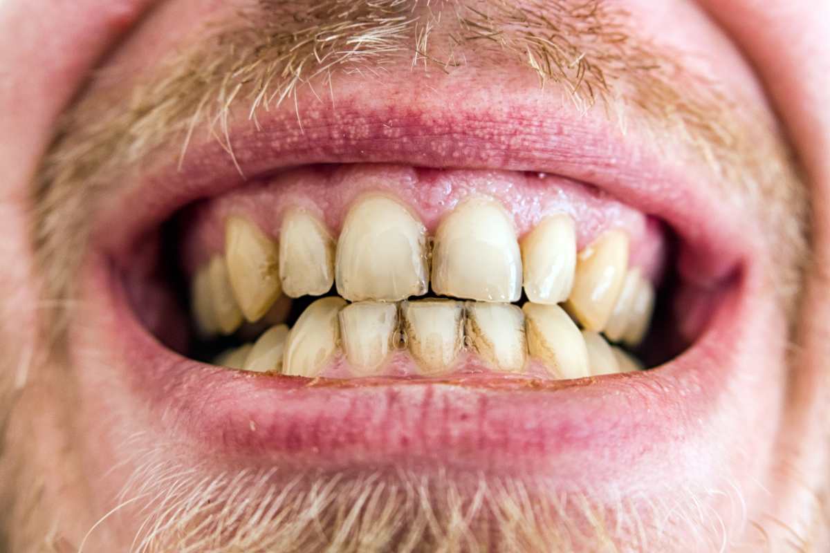 Manchas negras en los dientes, 5 motivos para alarmarse