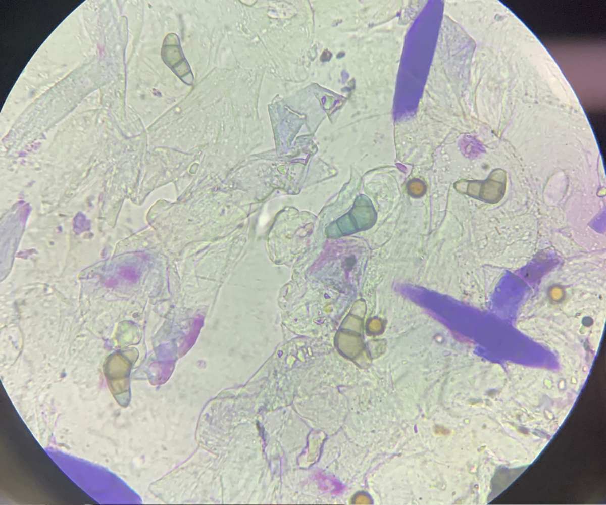 Helicobacter pylori en la boca