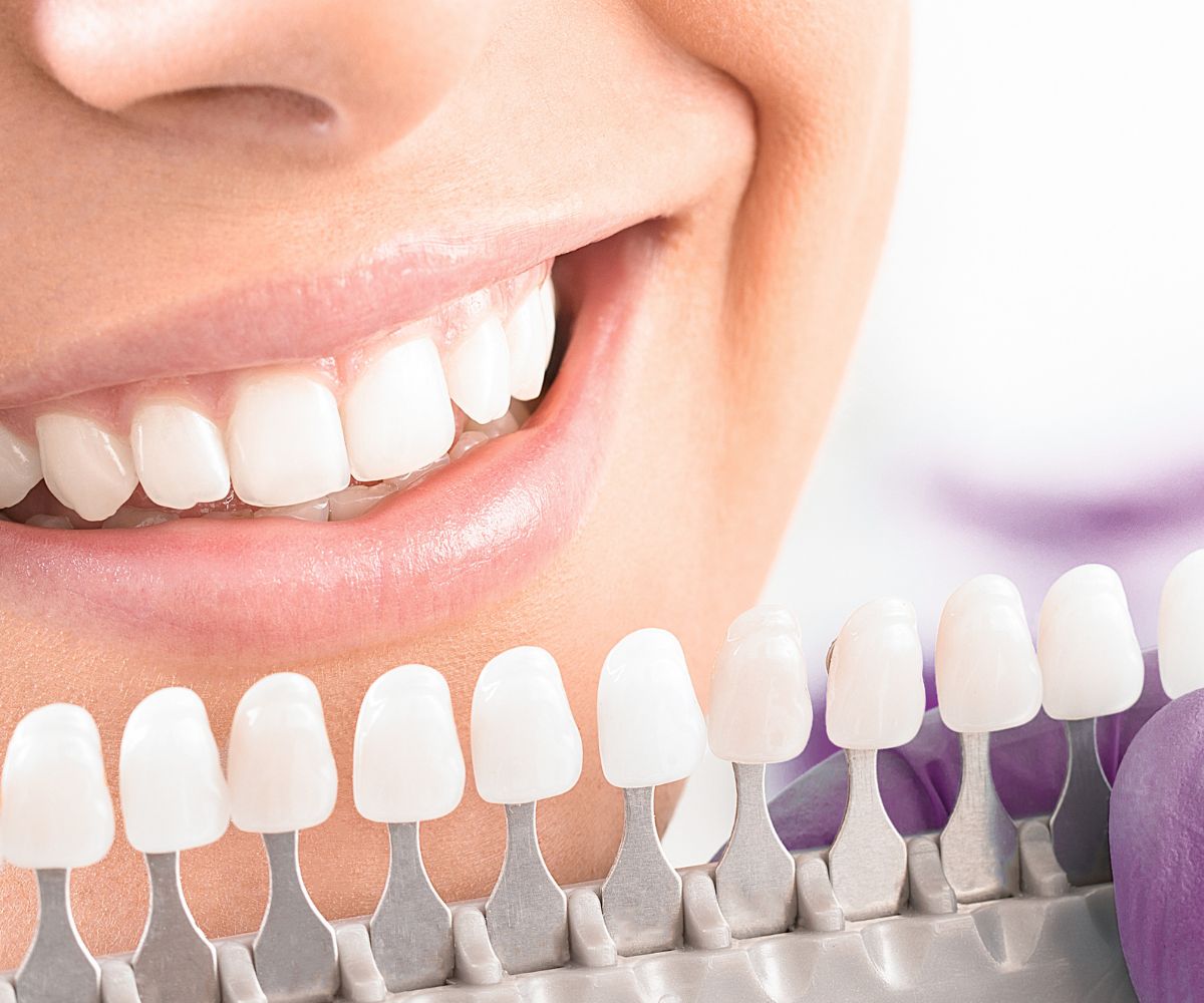 blanqueamiento dental con férulas en casa