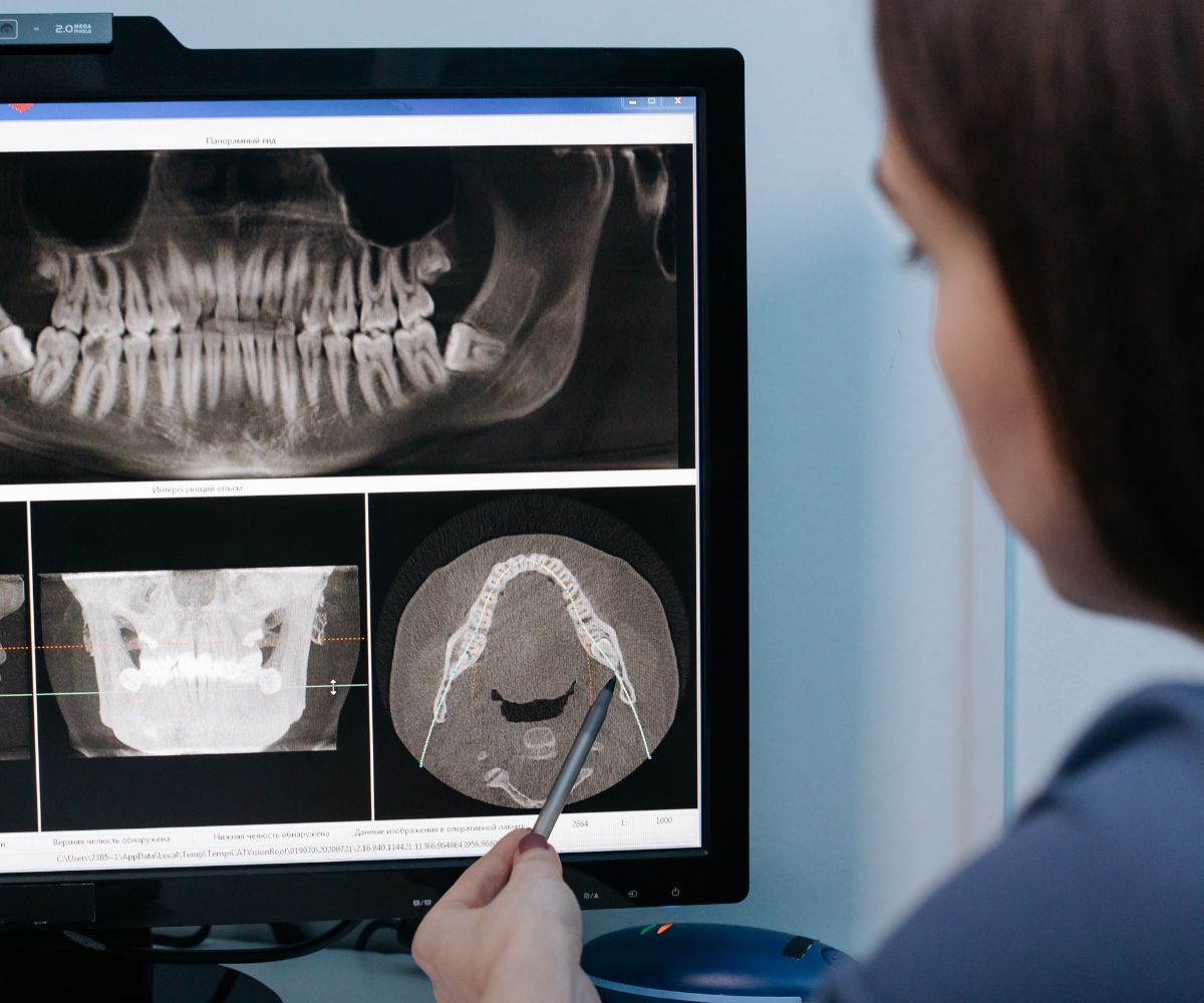 imagen-implantes-dentales-sin-hueso implantes dentales sin hueso